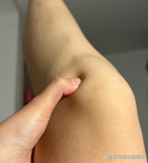 膝盖风湿的症状有哪些