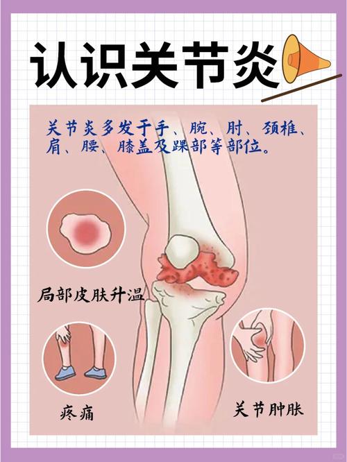 膝盖风湿的症状有哪些