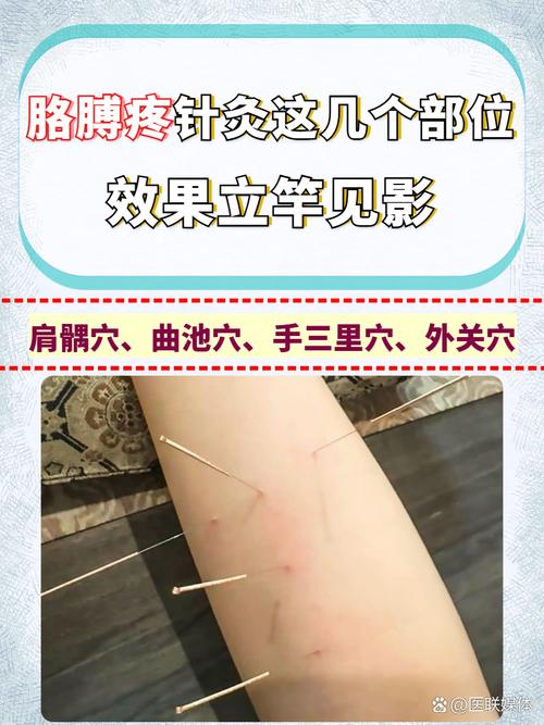 急性痛风的针灸穴位