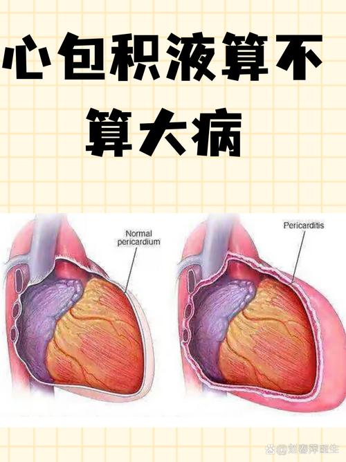 风湿心脏病 心包积液