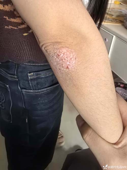 胳膊类风湿有什么症状