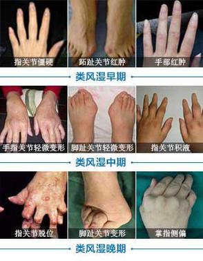 胳膊类风湿有什么症状