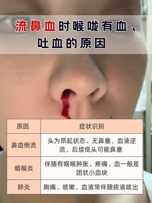 脑梗病人流鼻血是好事