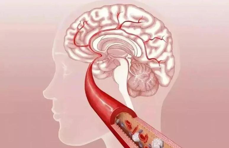 脑梗发作的症状有哪些