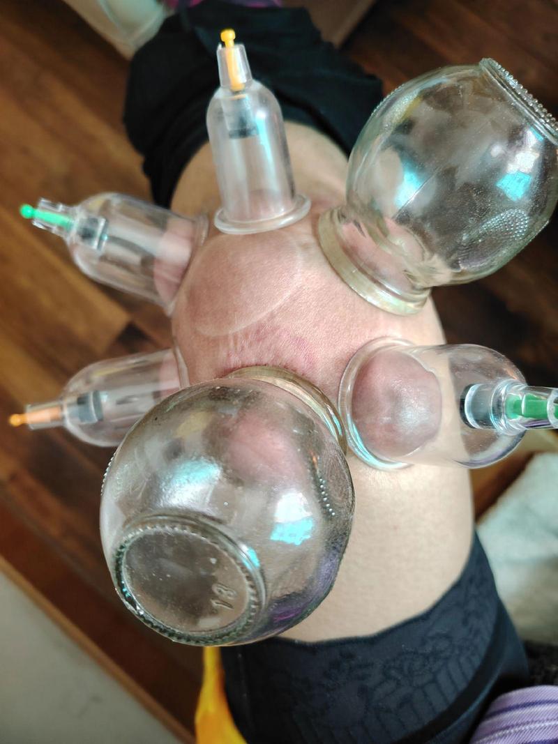 膝盖风湿拔火罐位置图