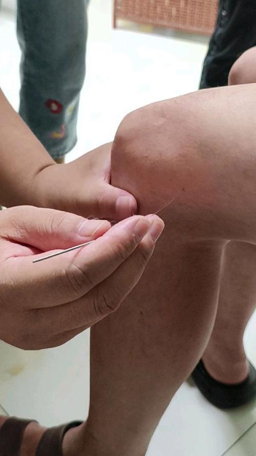 针灸血海穴位疼不疼