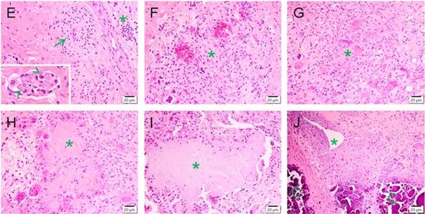 类风湿小结的病理改变