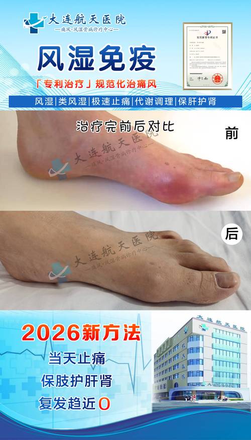 类风湿因子82严重吗