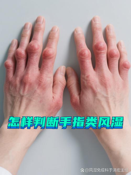 类风湿中期症状有哪些