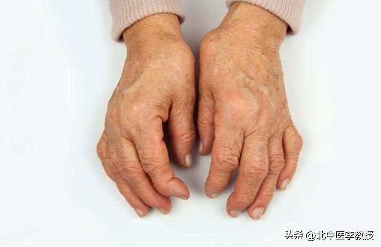 类风湿中期症状有哪些