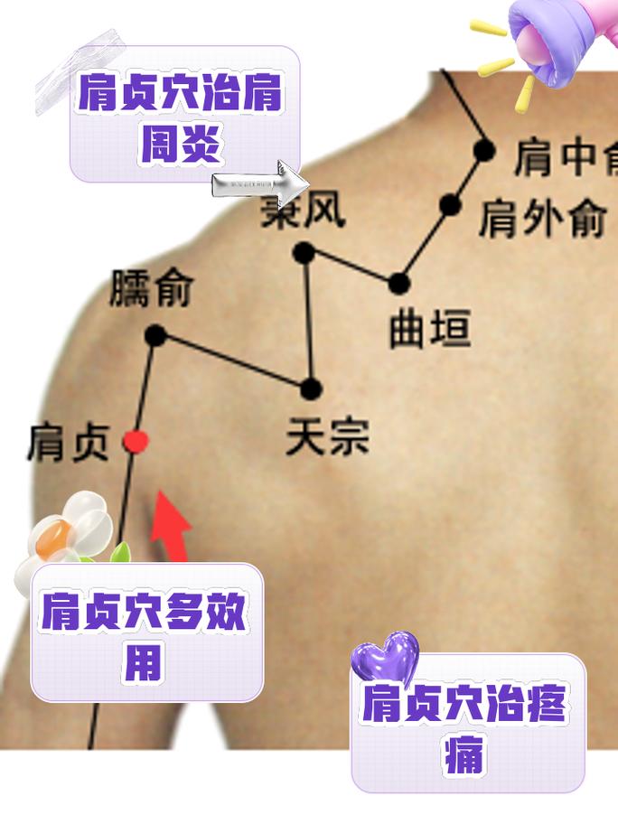 肩周炎针刺什么穴位