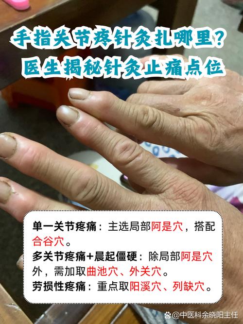 风湿手指关节疼痛艾灸