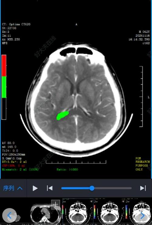脑梗ct能检查出来吗