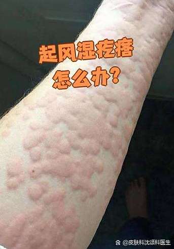 风湿疙瘩怎么引起的吗