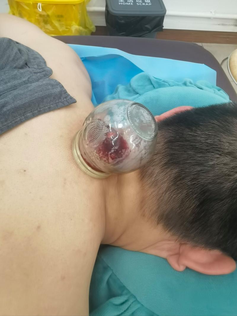 放血疗法 穴位放血