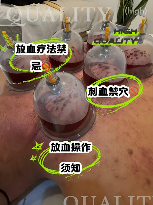 放血疗法 穴位放血