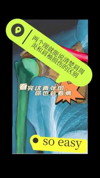 肩周炎与类风湿的区别