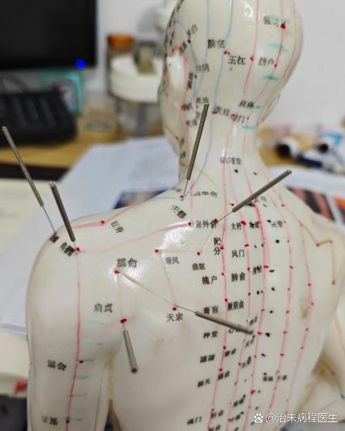 治疗肩周炎特效穴位