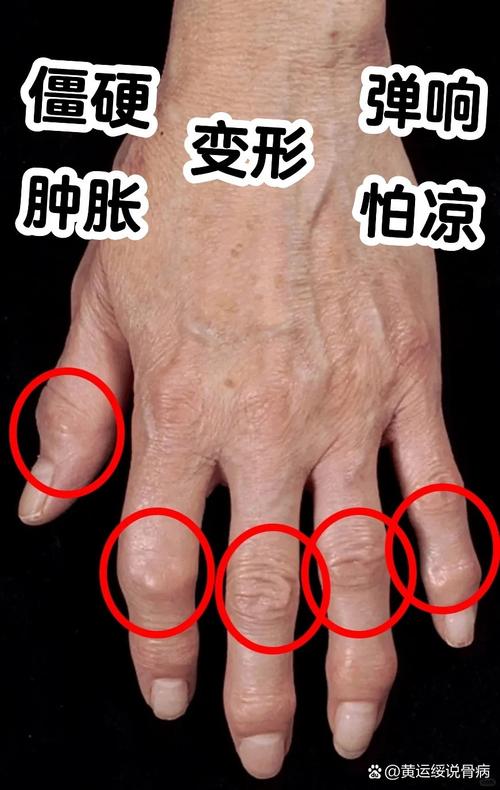 类风湿中期有什么症状