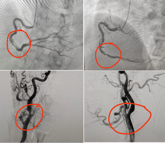 脑梗血管造影是手术